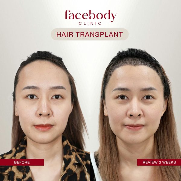 LINE_ALBUM_HAIR BA ผู้หญิง-(ปลูกผม คิ้ว)_241128_14