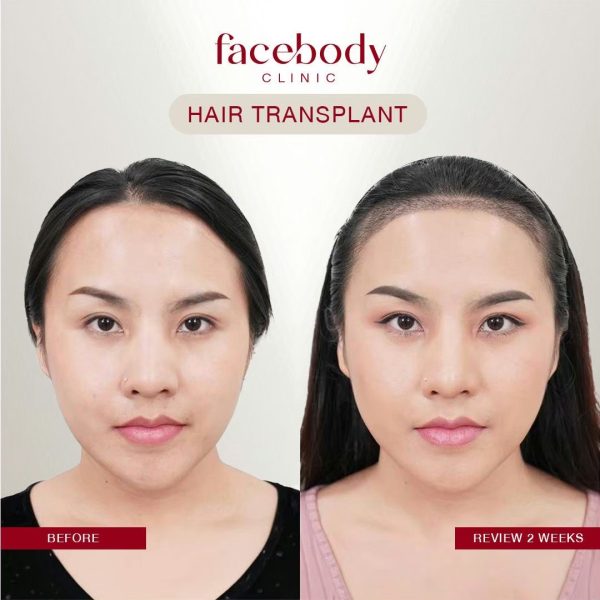 LINE_ALBUM_HAIR BA ผู้หญิง-(ปลูกผม คิ้ว)_241128_38