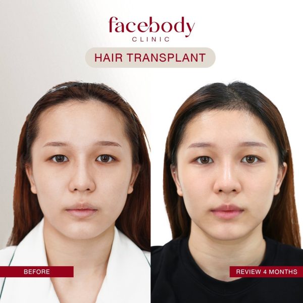 LINE_ALBUM_HAIR BA ผู้หญิง-(ปลูกผม คิ้ว)_241128_5