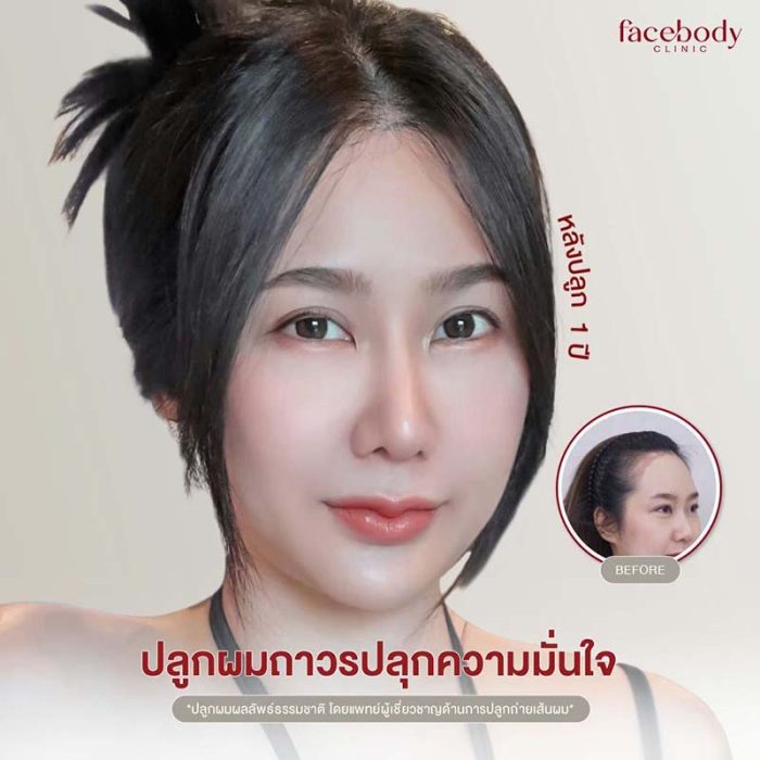 การปลูกผมผู้หญิงในปี 2025 มีตัวเลือกหลากหลายที่ออกแบบมาเพื่อตอบโจทย์แต่ละบุคคล โดยราคาค่าบริการขึ้นอยู่กับจำนวนกราฟต์ เทคนิคที่เลือกใช้ และมาตรฐานการดูแลของคลินิก โดยทั่วไป ราคาสำหรับการปลูกผมจำนวน 1,000-3,000 กราฟต์ จะอยู่ในช่วง 30,000 – 220,000 บาท ทั้งนี้ ขึ้นอยู่กับคุณภาพและประสิทธิภาพของการให้บริการแต่ละแห่ง