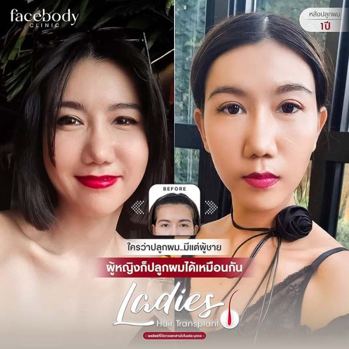 รูปแบบการปลูกผมยอดนิยมในผู้หญิง การปลูกผมแบบลดแนวไรผม เหมาะสำหรับผู้ที่ต้องการปรับแนวผมให้ต่ำลง หรือผู้ที่มีไรผมสูงโดยธรรมชาติ การปลูกคิ้ว ใช้รากผมจากศีรษะมาปลูกในบริเวณคิ้ว เพื่อให้คิ้วดูหนาและเต็มขึ้น