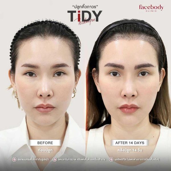 การประเมินและออกแบบ: แพทย์จะช่วยออกแบบคิ้วให้เหมาะสมกับใบหน้าและความต้องการของผู้ป่วย การเก็บกราฟต์ผม: ใช้เทคนิค FUE (Follicular Unit Extraction) เพื่อย้ายกราฟต์ผมที่แข็งแรง การปลูกกราฟต์: แพทย์จะปลูกเส้นขนทีละเส้นอย่างละเอียด เพื่อให้ผลลัพธ์ดูเป็นธรรมชาติ