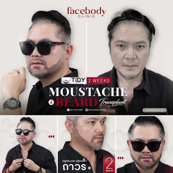 หนวดและเคราเป็นสัญลักษณ์ของความเป็นชายและสไตล์ของบุรุษหลายคน แต่สำหรับบางคนที่มีปัญหาเคราขึ้นไม่เต็ม หนวดบาง หรือรูปทรงไม่ชัด การปลูกหนวดและเคราเป็นวิธีที่ช่วยแก้ปัญหาได้อย่างมีประสิทธิภาพ เทคนิคที่ใช้จะคล้ายกับการปลูกคิ้ว โดยการย้ายกราฟต์ผมมาปลูกในบริเวณที่ต้องการ