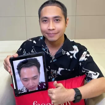 รีวิวปลูกผม (22)